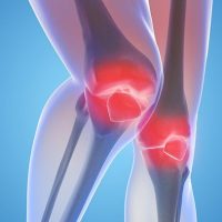 arthritis